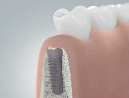 implantant-1