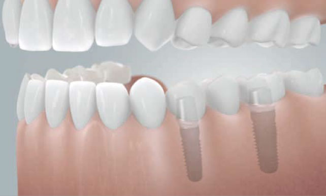 implantant-10