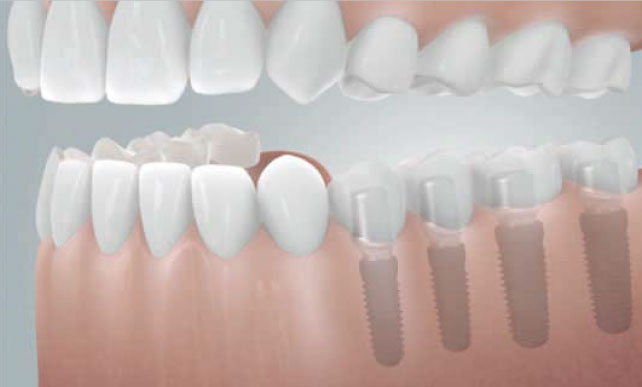 implantant-11