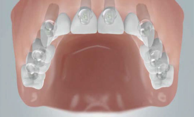 implantant-12