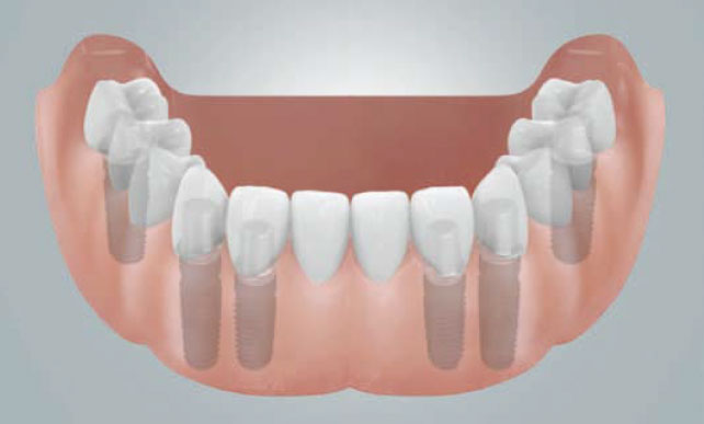 implantant-13