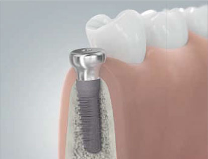 implantant-2