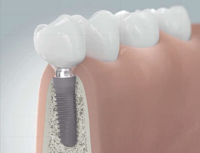implantant-3