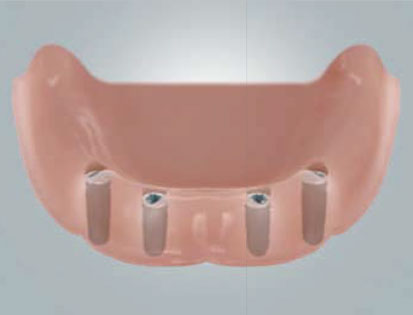 implantant-4