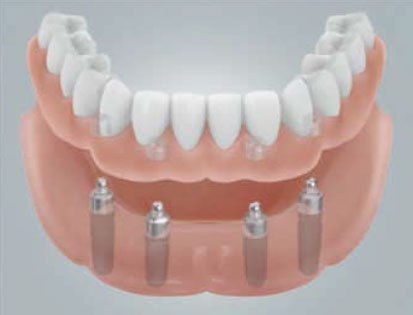 implantant-5