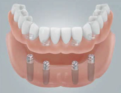 implantant-6