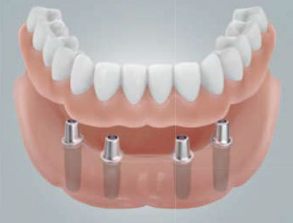 implantant-7