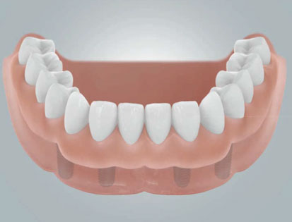 implantant-9